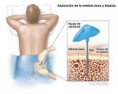 /album/fotogaleria/aspiracion-de-medula-osea-jpg/